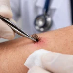 docteur pince et tiques