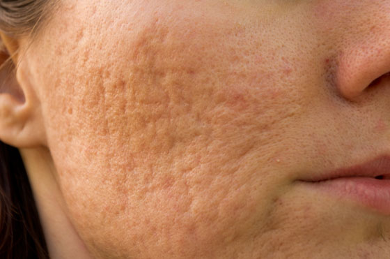 face with acne-damaged skin