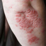 Psoriasis auf dem Arm